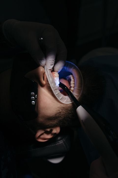 Blanqueamiento dental profesional