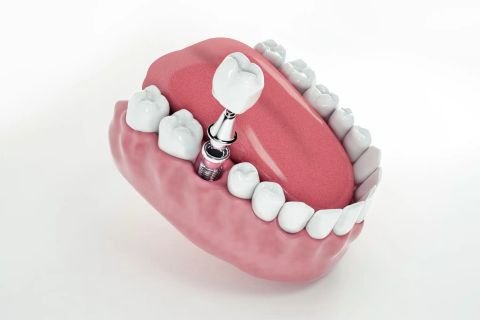 Implantes Dentales